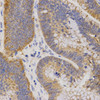 Immunohistochemistry of paraffin-embedded human rectal cancer using P2RY11 antibody (18-924) at dilution of 1:200 (40x lens) .