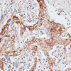Immunohistochemistry of paraffin-embedded human liver cancer using PIGR antibody (22-020) at dilution of 1:100 (40x lens) .