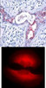 <b>Top Image:</b> Immunohistochemical analysis of paraffin-embedded human breast carcinoma tissue using GSK3&#946; (Phospho-Ser9) .<b>Bottom Image:</b> Immunofluorescence staining of methanol-fixed HeLa cells showing cytoplasmic staining using GSK3&#946; (Phospho-Ser9) .