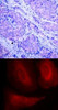<b>Top Image:</b> Immunohistochemical analysis of paraffin-embedded human breast carcinoma tissue using PDK1 (Phospho-Ser241) .<b>Bottom Image:</b> Immunofluorescence staining of methanol-fixed HeLa cells using PDK1 (Phospho-Ser241) .