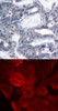 <b>Top Image:</b> Immunohistochemical analysis of paraffin-embedded human breast carcinoma tissue using MEK-2 (Phospho-Thr394) .<b>Bottom Image:</b> Immunofluorescence staining of methanol-fixed HeLa cells using MEK-2 (Phospho-Thr394) .