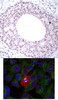 <b>Top Image:</b> Immunohistochemical analysis of paraffin-embedded human breast carcinoma tissue using NF&#954;B-p65 (Phospho-Thr254) .<b>Bottom Image:</b> Immunofluorescence staining of methanol-fixed HeLa using NF&#954;B-p65 (Phospho-Thr254) .