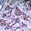 Immunohistochemical analysis of paraffin-embedded human breast carcinoma tissue using NF-kappaB p65 (phospho-Thr435) .
