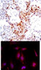 <b>Top Image:</b> Immunohistochemical analysis of paraffin-embedded human breast carcinoma tissue using ATF2 (Phospho-Thr69 or 51) .<b>Bottom Image:</b> Immunofluorescence staining of methanol-fixed HeLa cells using ATF2 (Phospho-Thr69 or 51) .