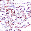 Immunohistochemical analysis of paraffin-embedded human breast carcinoma tissue using ATF2 (Phospho-Thr71 or 53) .