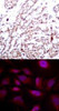 <b>Top Image:</b> Immunohistochemical analysis of paraffin-embedded human breast carcinoma tissue using ATF2 (Phospho-Thr73 or 55) .<b>Bottom Image:</b> Immunofluorescence staining of methanol-fixed HeLa cells using ATF2 (Phospho-Thr73 or 55) .