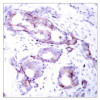 Immunohistochemical analysis of paraffin-embedded human breast carcinoma tissue using Myc (Phospho-Ser373) .