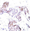 Immunohistochemical analysis of paraffin-embedded human breast carcinoma tissue using Elk1 (Phospho-Ser389) .