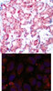 <b>Top Image:</b> Immunohistochemical analysis of paraffin-embedded human breast carcinoma tissue using GATA1 (Phospho-Ser142) .<b>Bottom Image:</b> Immunofluorescence staining of methanol-fixed HeLa cells using GATA1 (Phospho-Ser142) .