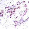 Immunohistochemical analysis of paraffin-embedded human breast carcinoma tissue using STAT1 (Phospho-Tyr701) .