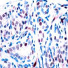 Immunohistochemical analysis of paraffin-embedded human breast carcinoma tissue using STAT3 (Phospho-Tyr705) .