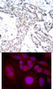 <b>Top Image:</b> Immunohistochemical analysis of paraffin-embedded human breast carcinoma tissue using STAT3 (Phospho-Ser727) .<b>Bottom Image:</b> Immunofluorescence staining of methanol-fixed HeLa cells using STAT3 (Phospho-Ser727) .