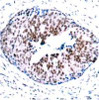 Immunohistochemical analysis of paraffin-embedded human breast carcinoma tissue using STAT5A (Phospho-Ser780) .