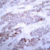 Immunohistochemical analysis of paraffin-embedded human breast carcinoma tissue using ATF4 (Phospho-Ser245) .