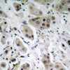 Immunohistochemical analysis of paraffin-embedded human breast carcinoma tissue using Akt (Phospho-Ser473) .