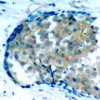 Immunohistochemical analysis of paraffin-embedded human breast carcinoma tissue using Ezrin (Phospho-Tyr353) .