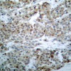 Immunohistochemical analysis of paraffin-embedded human breast carcinoma tissue using BAD (Phospho-Ser112) .