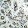 Immunohistochemical analysis of paraffin-embedded human breast carcinoma tissue using BAD (Phospho-Ser136) .