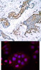 <b>Top Image:</b> Immunohistochemical analysis of paraffin-embedded human breast carcinoma tissue using Estrogen Receptor-&#945; (Phospho-Ser118) .<b>Bottom Image:</b> Immunofluorescence staining of methanol-fixed MCF cells using Estrogen Receptor-&#945; (Phospho-Ser118) .