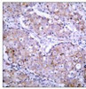 Immunohistochemical analysis of paraffin-embedded human breast carcinoma tissue using EGFR (Phospho-Ser1070) .