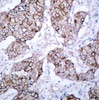 Immunohistochemical analysis of paraffin-embedded human breast carcinoma tissue using EGFR (Phospho-Tyr1092) .