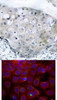 <b>Top Image:</b> Immunohistochemical analysis of paraffin-embedded human breast carcinoma tissue using VEGFR2 (Phospho-Tyr951) .<b>Bottom Image:</b> Immunofluorescence staining of methanol-fixed MCF7 cells using VEGFR2 (Phospho-Tyr951) .