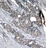 Immunohistochemical analysis of paraffin-embedded human breast carcinoma tissue using p53 (Phospho-Ser6) .