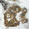 Immunohistochemical analysis of paraffin-embedded human lung carcinoma tissue using Akt2 (Phospho-Ser474) .