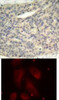 <b>Top Image:</b> Immunohistochemical analysis of paraffin-embedded human breast carcinoma tissue using LIMK1 (Phospho-Thr508) .<b>Bottom Image:</b> Immunofluorescence staining of methanol-fixed HeLa cells using LIMK1 (Phospho-Thr508) .
