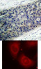 <b>Top Image:</b> Immunohistochemical analysis of paraffin-embedded human breast carcinoma tissue using LIMK2 (Phospho-Thr505) .<b>Bottom Image:</b> Immunofluorescence staining of methanol-fixed HeLa cells using LIMK2 (Phospho-Thr505) .