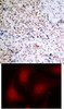 <b>Top Image:</b> Immunohistochemical analysis of paraffin-embedded human breast carcinoma tissue using Rb (Phospho-Ser795) .<b>Bottom Image:</b> Immunofluorescence staining of methanol-fixed HeLa cells using Rb (Phospho-Ser795) .
