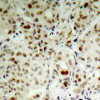 Immunohistochemical analysis of paraffin-embedded human breast carcinoma tissue using Rb (Phospho-Ser807) .