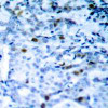 Immunohistochemical analysis of paraffin-embedded human breast carcinoma tissue using CDC2 (Phospho-Thr161) .