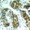 Immunohistochemical analysis of paraffin-embedded human breast carcinoma tissue using cdc25A (Phospho-Ser76) .