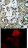 <b>Top Image:</b> Immunohistochemical analysis of paraffin-embedded human breast carcinoma tissue using MKK3 (Phospho-Ser189) .<b>Bottom Image:</b> Immunofluorescence staining of methanol-fixed HeLa cells using MKK3 (Phospho-Ser189) .