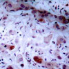 Immunohistochemical analysis of paraffin-embedded human breast carcinoma tissue using JAK1 (Phospho-Tyr1022) .