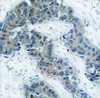 Immunohistochemical analysis of paraffin-embedded human breast carcinoma tissue using JAK2 (Phospho-Tyr1007) .