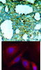 <b>Top Image:</b> Immunohistochemical analysis of paraffin-embedded human breast carcinoma tissue using PAK1 (Phospho-Thr212) .<b>Bottom Image:</b> Immunofluorescence staining of methanol-fixed HeLa cells using PAK1 (Phospho-Thr212) .