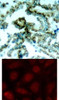<b>Top Image:</b> Immunohistochemical analysis of paraffin-embedded human lung carcinoma tissue, using PKC&#946; (phospho-Thr641) .<b>Bottom Image:</b> Immunofluorescence staining of methanol-fixed MCF7 cells using PKC&#946; (phospho-Thr641) antibody (#11172, Red) .