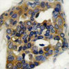 Immunohistochemical analysis of paraffin-embedded human breast carcinoma tissue using ASK1 (Phospho-Ser966) .