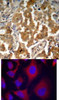 <b>Top Image:</b> Immunohistochemical analysis of paraffin-embedded human lung carcinoma tissue using ADD1 (Phospho-Ser726) .<b>Bottom Image:</b> Immunofluorescence staining of methanol-fixed HeLa cells using ADD1 (Phospho-Ser726) .