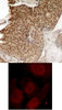 <b>Top Image:</b> Immunohistochemical analysis of paraffin-embedded human breast carcinoma tissue using HDAC2 (Phospho-Ser394) .<b>Bottom Image:</b> Immunofluorescence staining of methanol-fixed HeLa cells showing nuclear staining using HDAC2 (Phospho-Ser394) .