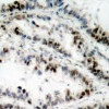 Immunohistochemical analysis of paraffin-embedded human lung carcinoma tissue using SMC1 (Phospho-Ser957) .