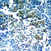 Immunohistochemical analysis of paraffin-embedded human tonsil tumor tissue using Bcr (Phospho-Tyr177) .