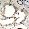 Immunohistochemical analysis of paraffin-embedded human breast carcinoma tissue using IkappaB-&#949; (Phospho-Ser22) .