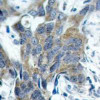 Immunohistochemical analysis of paraffin-embedded human breast carcinoma tissue using &#946;-Catenin (Phospho-Ser33) .