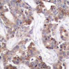Immunohistochemical analysis of paraffin-embedded human breast carcinoma tissue using Stathmin 1 (Phospho-Ser25) .