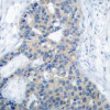 Immunohistochemical analysis of paraffin-embedded human breast carcinoma tissue using Stathmin 1 (Phospho-Ser38) .
