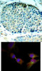 <b>Top Image:</b> Immunohistochemical analysis of paraffin-embedded human breast carcinoma tissue using HSP27 (Phospho-Ser78) .<b>Bottom Image:</b> Immunofluorescence staining of methanol-fixed HeLa cells showing cytoplasmic, nuclear, centrosomal, midbody staining using HSP27 (Phospho-Ser78) .