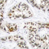 Immunohistochemical analysis of paraffin-embedded human breast carcinoma tissue using RelB (Phospho-Ser573) .